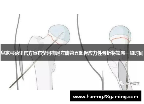 皇家马德里官方宣布楚阿梅尼左脚第五跖骨应力性骨折将缺席一段时间